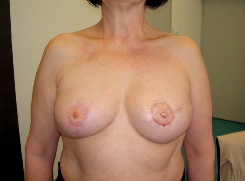 Intervention de reconstruction mammaire - aprs